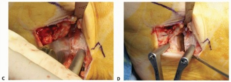 Illustration 54 for Medial Ankle Instability: Find Relief with Reconstruction