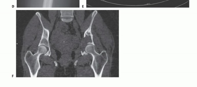 Illustration 11 for Pelvic Metastasis Surgery: A Component of the Utilitarian Approach