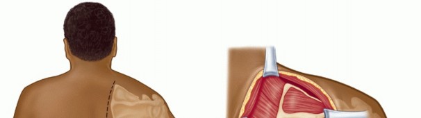 Illustration 13 for Snapping Scapula Syndrome: Why Your Shoulder Clicks & What to Do