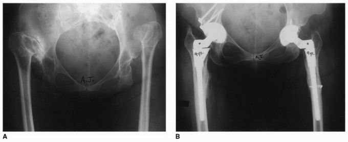 Illustration 24 for Recreate Hip Biomechanics: Modular Stems for Modular Solutions