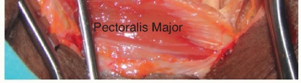 Illustration 31 for Restore Shoulder Function with Latissimus Dorsi Tendon Transfer