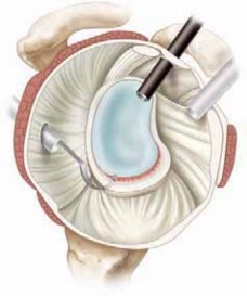 Illustration 22 for Regain Stability: Anterior Shoulder Instability Arthroscopic Fix