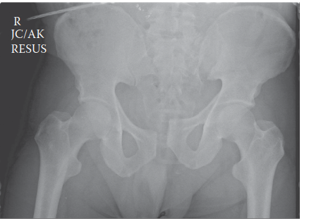 Illustration of fracture case pelvic fracture - Dr. Mohammed Hutaif