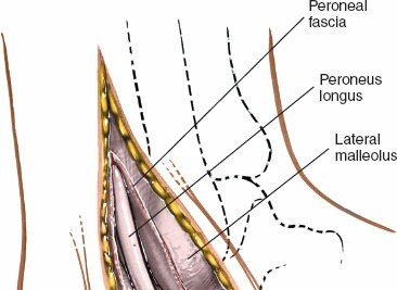 Illustration 122 for Optimized Approaches to the Dorsum of the Foot & Ankle