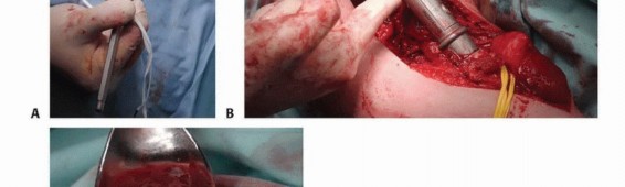 Illustration 32 for Restore Vital Function: Surgery for Type II Humeral Metastasis