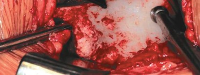 Illustration 50 for Bernese PAO: Unlocking the Procedure with Level V Evidence Insights