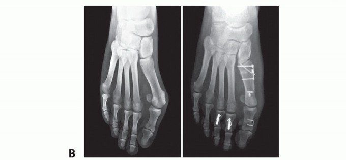 Illustration 35 for Mastering the Biplanar Distal Chevron for Effective Bunion Surgery