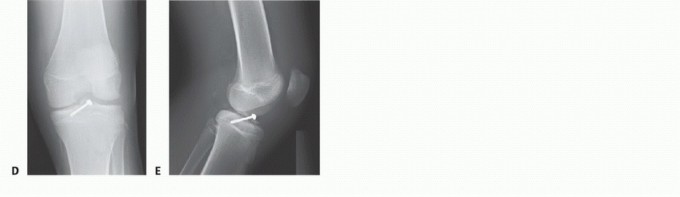 Illustration 16 for Treating Tibial Spine Fractures: Arthroscopy or Open Reduction?
