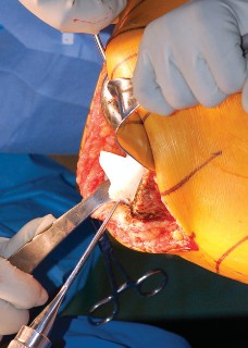 Illustration 14 for Mastering Gap Balancing in Revision TKA: Avoid Common Pitfalls