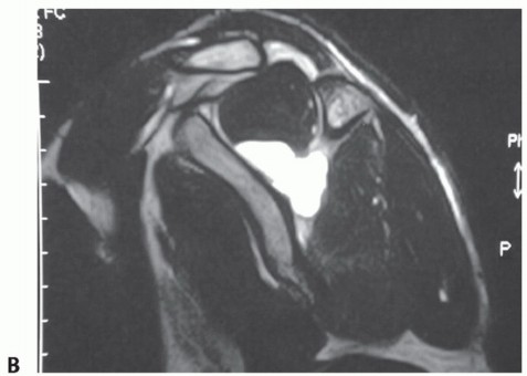 Illustration 8 for Decompressing the Transverse Scapular Ligament for Shoulder Pain Relief