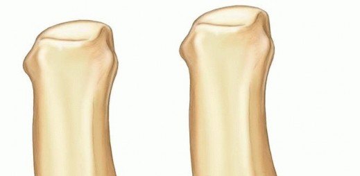Operative Treatment of Thumb Carpometacarpal Joint Fractures
