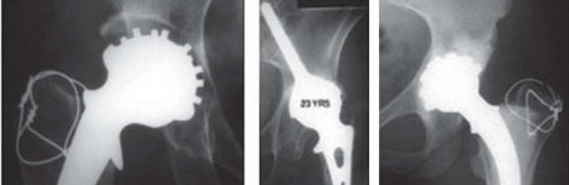 Illustration 13 for Mastering Hip Arthroplasty: Its Evolution and Design Unveiled