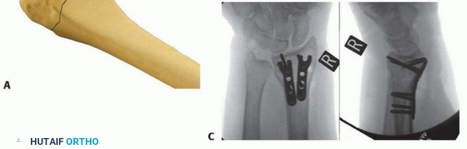 Illustration 31 for Fragment-Specific Fixation: Restore Carpal Facet Horizon