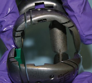 Illustration 22 for Understand Augments: The Role of Metal Augments in Arthroplasty