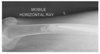 Illustration 51 for Cement in Cement Revision: Simplifying Complex Hip Revisions