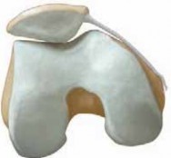 Patellar Instability Explained: What Causes Patellar Dislocation?