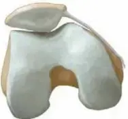 صورة توضيحية لـ عدم استقرار الرضفة: الدليل الشامل لفهم وعلاج "صابونة الركبة المتحركة"