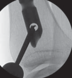 Illustration 50 for Optimal Nailing of the Tibia: Techniques for Challenging Fractures