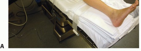 Illustration 18 for Unlock Stability: Medullary Nail Fixation for Tibiotalocalcaneal Arthrodesis