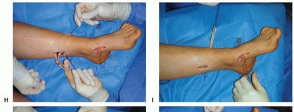 Illustration 21 for How Achilles Tendon Lengthening Fixes Equinocavovarus Foot