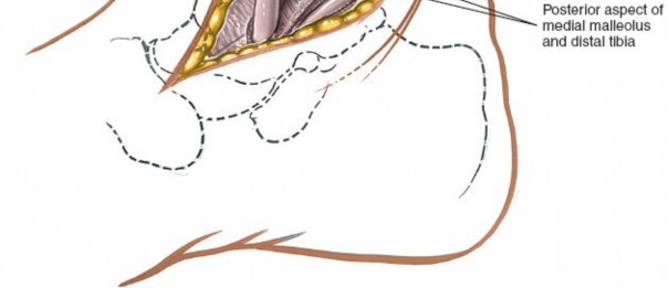 Illustration 30 for Optimized Approaches to the Dorsum of the Foot & Ankle