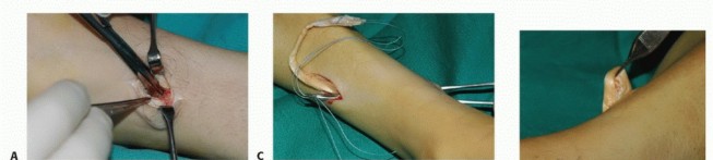 Illustration 11 for Foot Drop Surgery: How a Pin or Drill Elevates Tendon Transfer