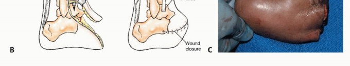 Illustration 29 for Treating Tumors of the Foot: Optimizing Amputation & Resection