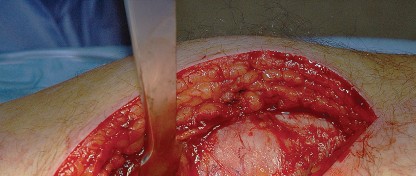 Illustration 16 for Unlock the Figure Posterior Approach to the Hip