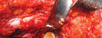 Illustration 24 for The Silent Hip: Achieving a Truly Silent, Pain-Free Joint