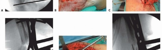Illustration 50 for Repairing Distal Femur Fractures: Open Reduction & Internal Fixation