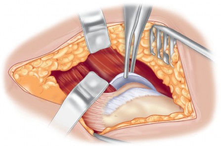 Illustration 3 for Mastering Direct Lateral Exposure for Revision Total Hip Success