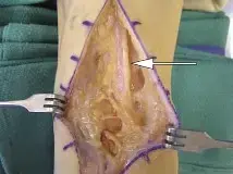 صورة توضيحية لـ دليل شامل لجراحات العظام: المداخل الجراحية، المخاطر، والتعافي مع الأستاذ الدكتور محمد هطيف في صنعاء