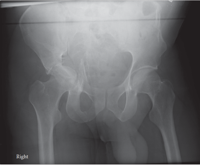 Acetabulum Fracture: Navigate High-Energy Acetabulum Injuries