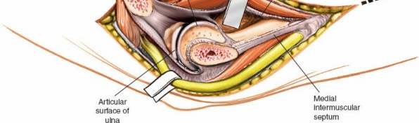 Illustration 41 for Mastering Elbow Approaches: Applied Surgical Anatomy for Precision