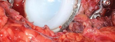 Illustration 60 for Management of Periprosthetic Fractures: An Expert Surgical Guide