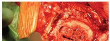 Illustration 6 for Why Polished Tapered Cemented Stems Excel in Hip Replacement