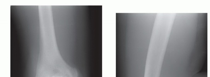 Arthroscopic Debridement for Elbow: Lasting Relief from Joint Pain