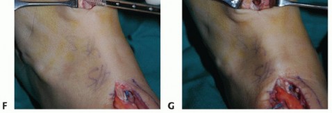 Illustration 59 for Restore Movement: Tendon Transfer for Common Peroneal Nerve Foot Drop