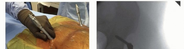 Illustration 39 for Emergency Fixation of the Pelvis: Control Bleeding & Restore Stability