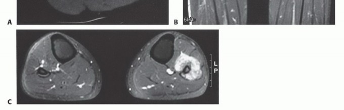 Illustration 5 for Beyond Amputation: The Type I Resection in Fibular Tumor Surgery