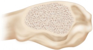 Illustration 8 for Cemented Femoral Stem Figures: Surgical Anatomy & Placement