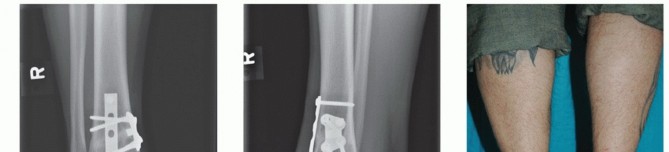 Illustration 45 for Unlock Healing: Medial Malleolar Osteotomy for Talus OLT Allografts