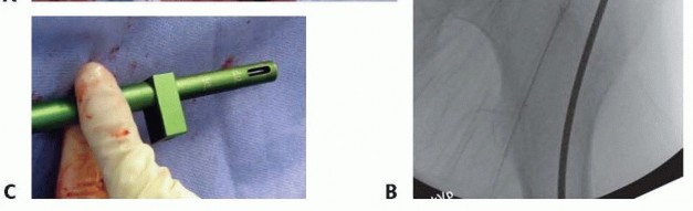 Illustration 18 for Pediatric Femoral Nailing: Targeting the Right aspect of the greater Trochanter