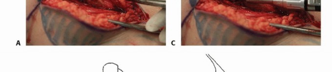 Illustration 5 for Avoid Major Surgery: Bone Tumor Treatment with Liquid Nitrogen Pour