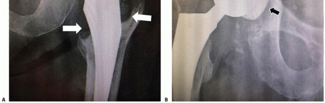 Illustration 13 for Which Bearing Surface Options Are Best for Your Total Hip?