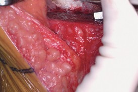 Illustration 37 for Mastering Valgus Total Knee Replacement: Techniques & Pitfalls