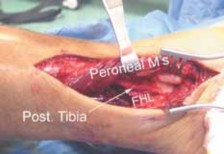 Illustration 38 for Optimizing ORIF for Tibial Plafond Fractures: A Modern Approach