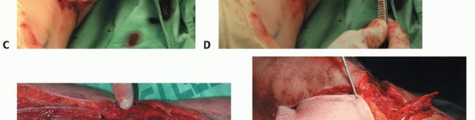 Illustration 29 for Free Vascularized Fibular Grafts: Solving Complex Bone Defects