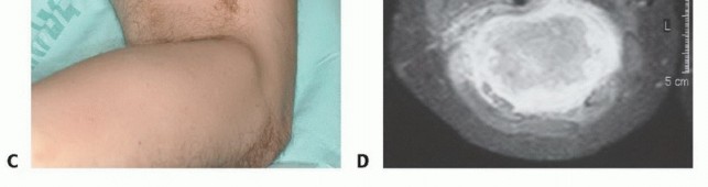 Illustration 7 for Posterior Thigh Resection: Rethinking Outcomes & Limb Sparing