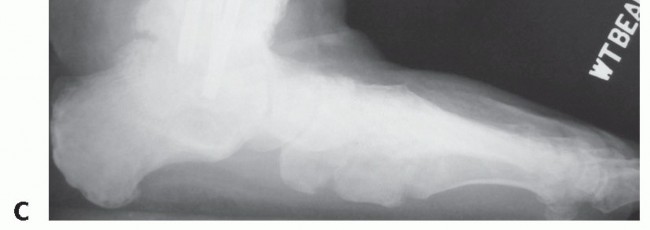 Illustration 8 for Unlock Stability: Medullary Nail Fixation for Tibiotalocalcaneal Arthrodesis